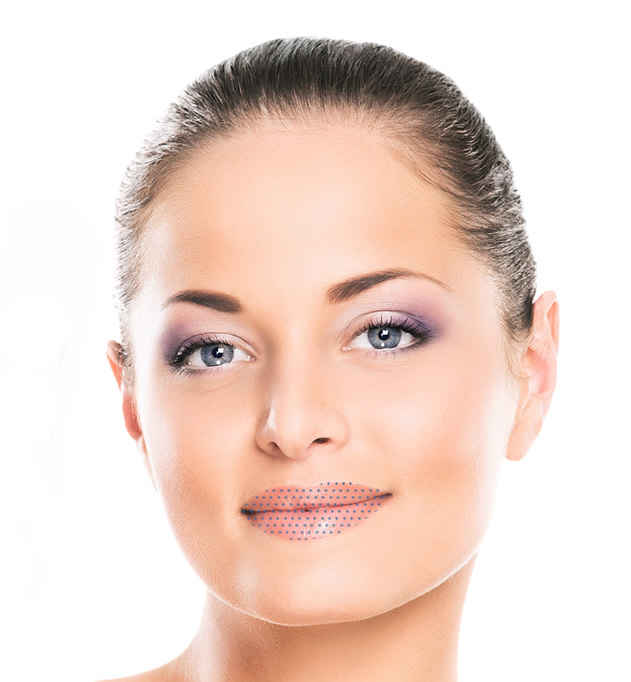 Injection d'acide hyaluronique - volume des lèvres